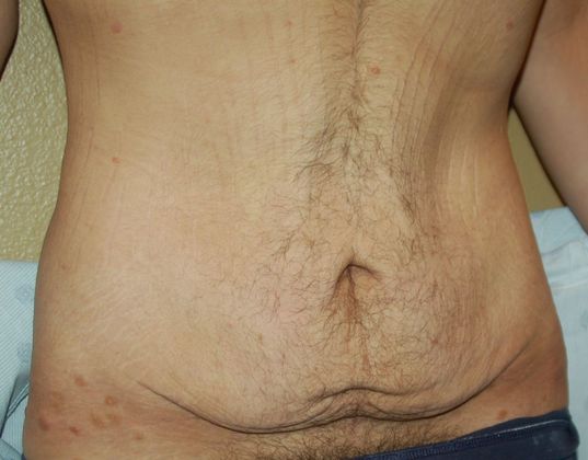 Massive Weight Loss : Case 73 - Before