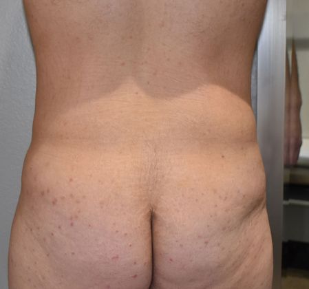 Buttock Lift Case 7 - Before