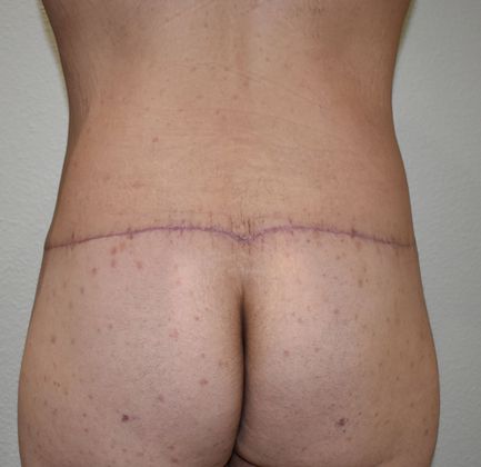 Buttock Lift Case 7 - After