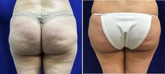 Body Buttock Enhancement: Case 4 (30104) - Before & After, fuller & rounder buttocks