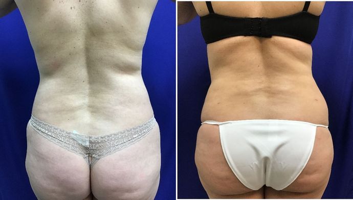 Body Buttock Enhancement: Case 4 (30104) - Before & After
