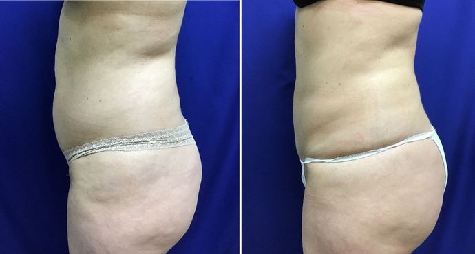 Body Buttock Enhancement: Case 4 (30104) - Before & After