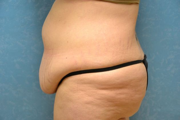 Tummy Tuck: Case 1695- Camden, MI - Before