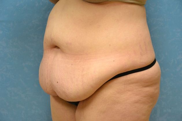 Tummy Tuck: Case 1695- Camden, MI - Before