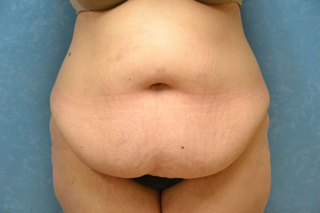 Tummy Tuck: Case 1695- Camden, MI - Before
