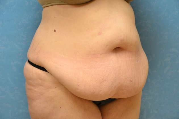Tummy Tuck: Case 1695- Camden, MI - Before