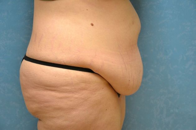 Tummy Tuck: Case 1695- Camden, MI - Before