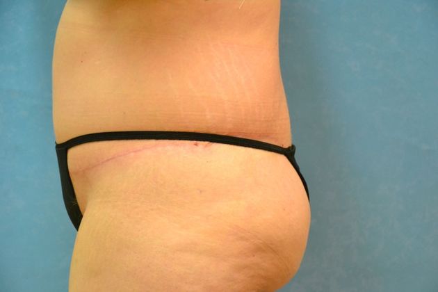 Tummy Tuck: Case 1695- Camden, MI - After