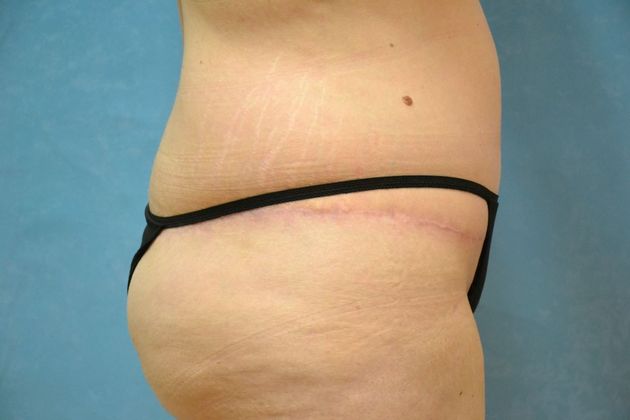 Tummy Tuck: Case 1695- Camden, MI - After