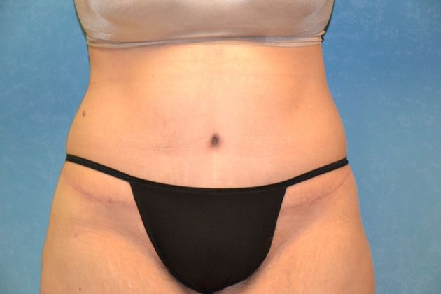 Tummy Tuck: Case 1695- Camden, MI - After