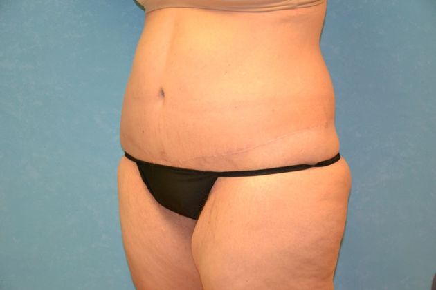 Tummy Tuck: Case 1695- Camden, MI - After
