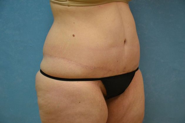 Tummy Tuck: Case 1695- Camden, MI - After