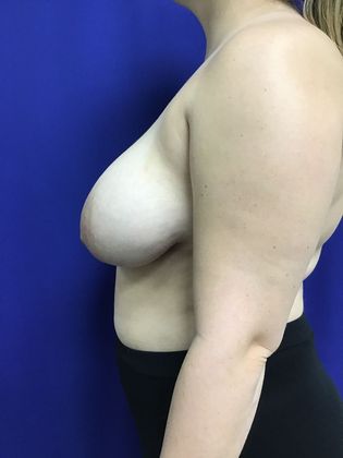 Breast Reduction: Case 30 (30149) - Before