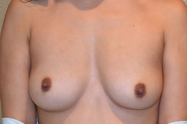 Breast Augmentation Case 599 - Before
