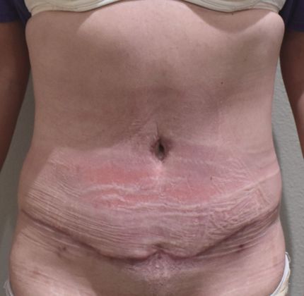 Tummy Tuck (Abdominoplasty): Case 237 - After