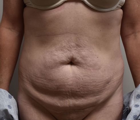 Tummy Tuck (Abdominoplasty): Case 237 - Before