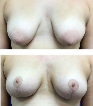 Breast Areola Reduction Case 2 (30029)