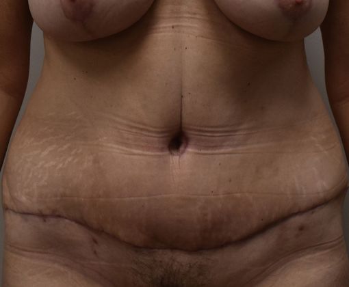 Tummy Tuck (Abdominoplasty): Case 238 - After