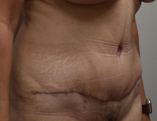 Tummy Tuck (Abdominoplasty): Case 238 - After