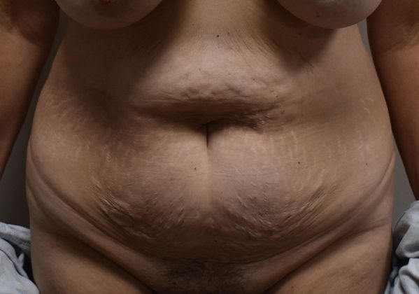 Tummy Tuck (Abdominoplasty): Case 238 - Before
