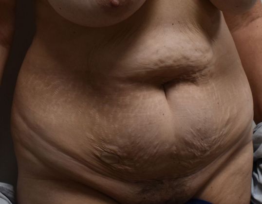 Tummy Tuck (Abdominoplasty): Case 238 - Before