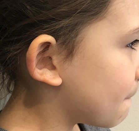 Otoplasty Case 8 Otoplasty, Preston, CT - Before