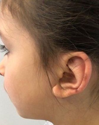 Otoplasty: Case 8 Otoplasty, Preston, CT - Before