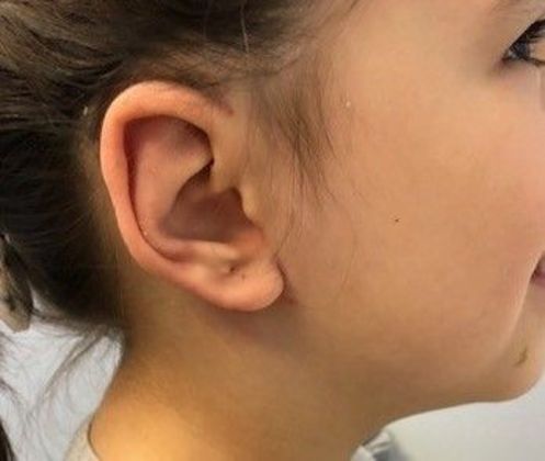 Otoplasty Case 8 Otoplasty, Preston, CT - After