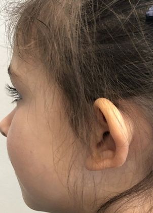 Otoplasty: Case 8 Otoplasty, Preston, CT - Before