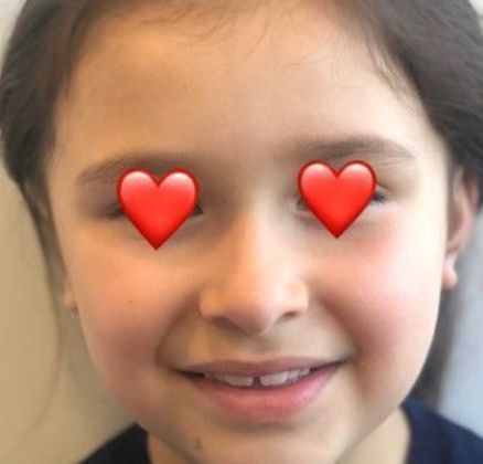 Otoplasty: Case 8 Otoplasty, Preston, CT - After