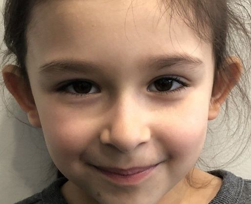 Otoplasty: Case 8 Otoplasty, Preston, CT - Before