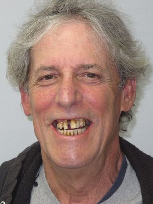 Teeth in a Day: Wow! Richard looks like a new person - Before