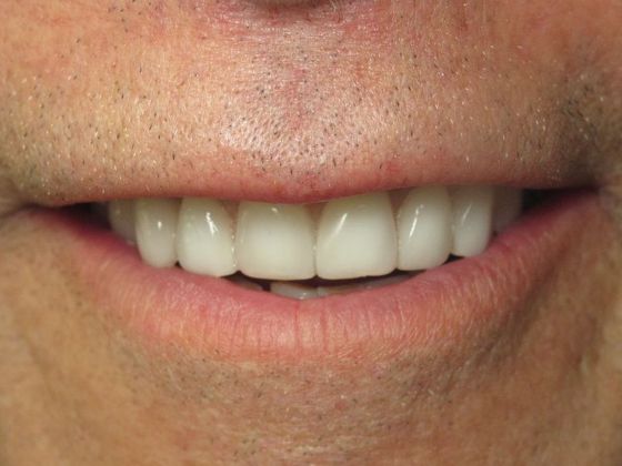 Teeth in a Day: Wow! Richard looks like a new person - After