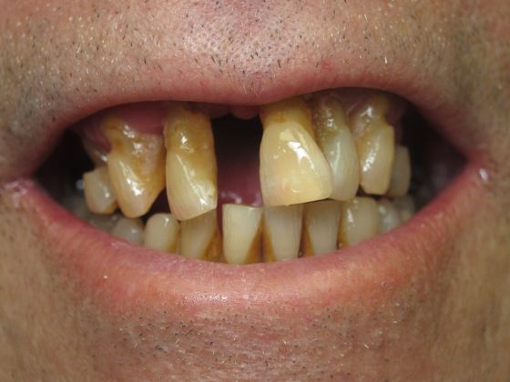 Teeth in a Day: Wow! Richard looks like a new person - Before