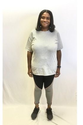 Patient Transformation Stories: Bridgette Lost 110 Pounds With a Revision! - After