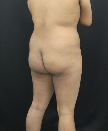 Liposuction: Case 20 - Before