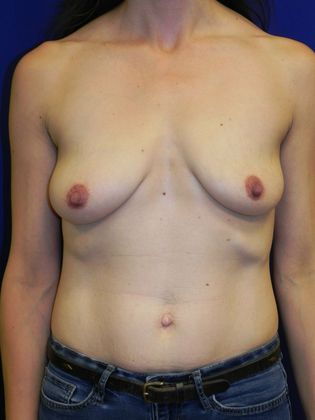 Breast Asymmetry / Deformity: Case 5 (22240) - Before