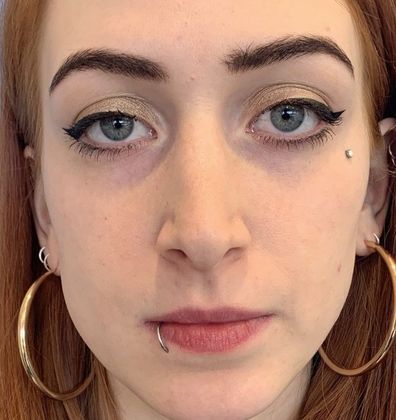 Rhinoplasty: Case 22 Revision Rhinoplasty, Wilton, CT - Before