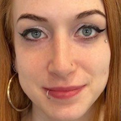 Rhinoplasty: Case 22 Revision Rhinoplasty, Wilton, CT - After