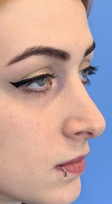 Rhinoplasty: Case 22 Revision Rhinoplasty, Wilton, CT - Before