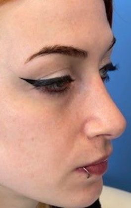 Rhinoplasty: Case 22 Revision Rhinoplasty, Wilton, CT - After