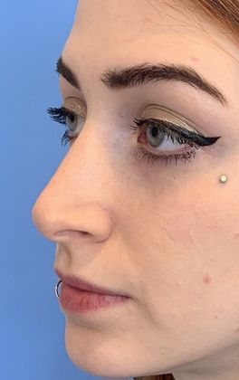 Rhinoplasty: Case 22 Revision Rhinoplasty, Wilton, CT - Before