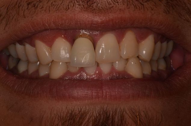 Dental Implants: Case 35 - Before