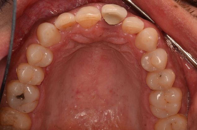 Dental Implants: Case 35 - Before