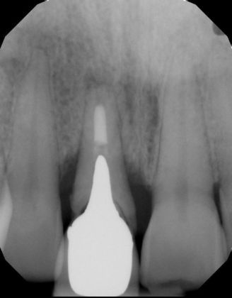 Dental Implants Case 35 - Before