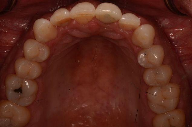 Dental Implants: Case 35 - After