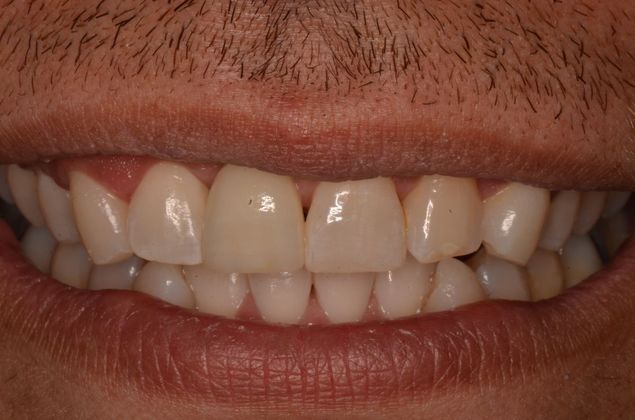 Dental Implants: Case 35 - After