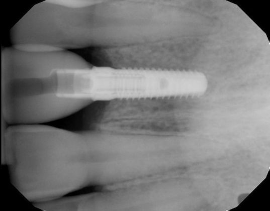 Dental Implants Case 35 - After