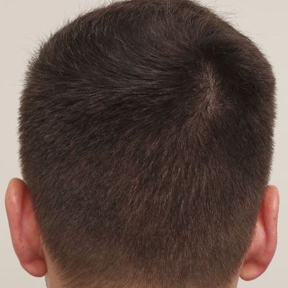 Hair Transplant - Donor Area Afters: FUE - After 1500 FUE extractions