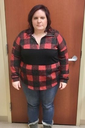  Patient Transformation Stories Maria Is Back On Her Honeymoon! - Before